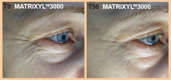 Matrixyl 3000 Before and after clinical trials results