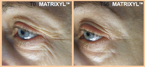 Matrixyl Before and after clinical trials results