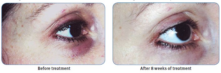 Regu Age Before and After Results